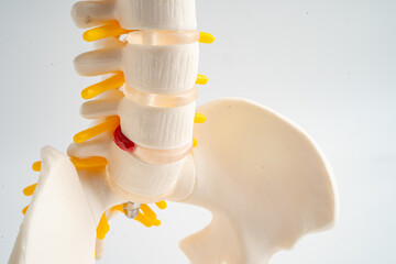 Lumbar spine displaced herniated disc fragment, spinal nerve and bone. Model for treatment medical in the orthopedic department.