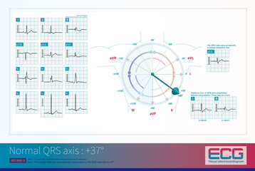 When the frontal plane axis is at +37 &deg;, the maximum QRS excitation potential is most perpendicular to the axis of lead III, resulting in the lowest QRS wave amplitude in lead III.
