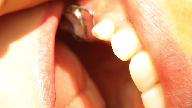 Pediatric dental space maintainer inside a child&rsquo;s mouth, showing metal structure. It preserves space after early tooth loss and helps prevent future misalignment, ideal for medical use.