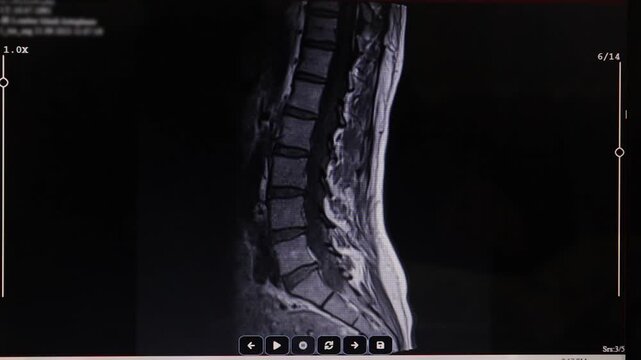 Doctor examines an MRI scan of the lumbar spine, highlighting a mild broad-based L5-S1 disc protrusion. This scene is ideal for medical education, spinal health awareness, and diagnostic presentations