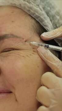 Close-up of a cosmetic injection near the eye area of a mature Caucasian woman. A professional in medical black gloves performs an anti-wrinkle skin treatment in a clinical setting