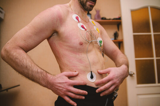 Man with severe urticaria/hives and ECG electrodes on his chest and abdomen. Depicts skin allergy, health issues, and medical examination for diagnosis and monitoring.
