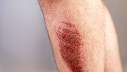 Fototapeta premium Severe scuffing of the skin on the male shin, Injury, abrasion close-up. High quality photo