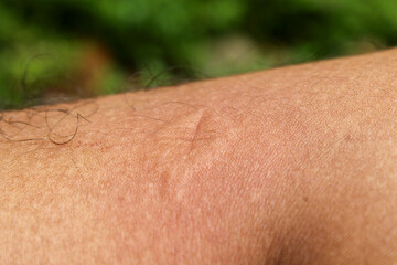 Fototapeta premium Close up of a bump on the skin of the leg marked with an X