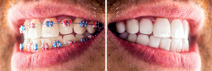 Closeup man with teeth before and after braces treatment. Dental braces, correcting teeth