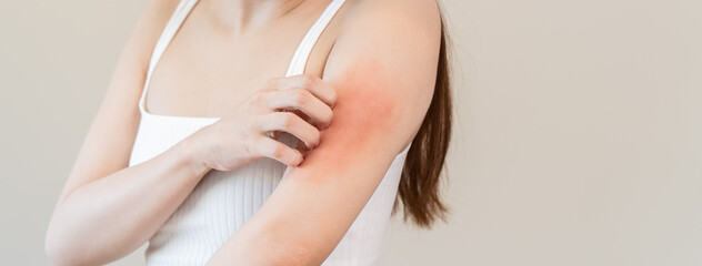 Sensitive skin allergic concept, Woman itching on her arm have a red rash from allergy symptom and from scratching.