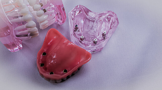 Implant model showing four inserted dental implants with an overdenture placed beside it, presented on a white surface for educational demonstration of full-arch implant prosthetics.
