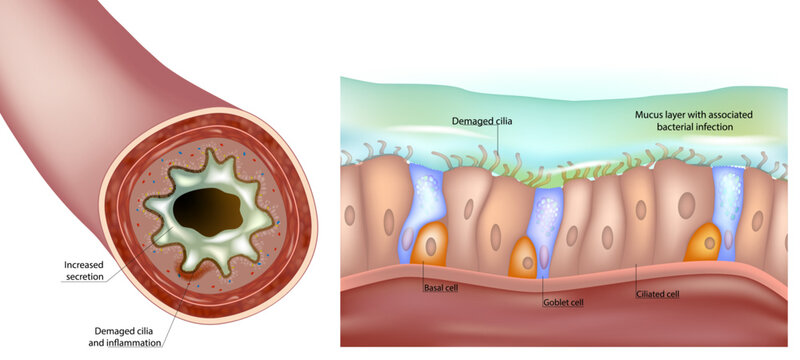 Medical illustration showing damage to the respiratory epithelium, impaired cilia, increased mucus production, airway inflammation, and bacterial infection. Cross-section of the bronchial lumen 