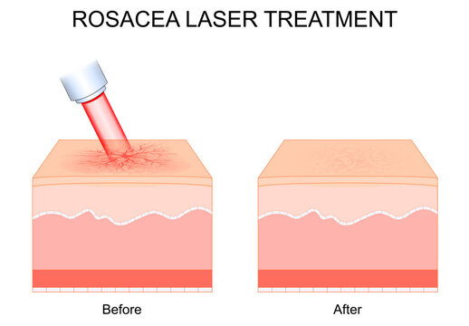 Rosacea laser treatment. Telangiectasia removal