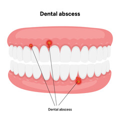 Hand-drawn dental illustration tooth with a dental abscess, visible infection, swollen gum area, and underlying anatomical structures