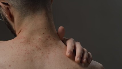 Rear view close up shot of man with bare back suffering from skin condition scratching shoulder on minimal grey background in studio