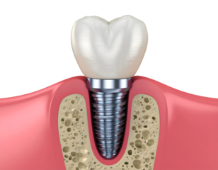 3D dental implant isolated on transparent background