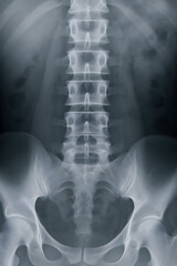 腰椎X線画像（L1〜L5）正面ビュー / Lumbar Spine X-Ray Showing Vertebrae L1&ndash;L5