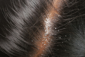 Dandruff and dry scalp visible on dark hair strands