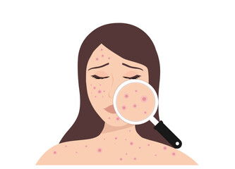  Dermatologist checking young woman face with skin acne, pimples, blackheads vector illustration. Acne skin face problem concept

