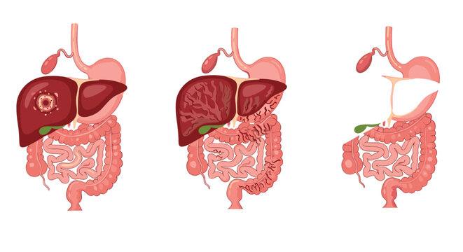 Medical infographic showing the progression of liver disease, including cancer, cirrhosis, and resulting in a partial gastrectomy.