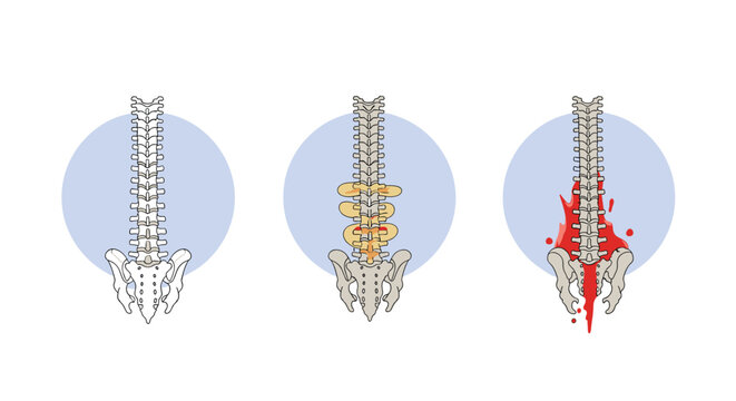Medical illustrations comparing a normal spine with conditions like osteoporosis and ankylosing spondylitis or severe inflammation.