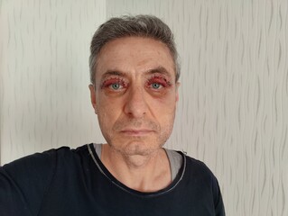Obraz premium Close-up of Middle-Aged Man 2 Days Post-Upper Blepharoplasty and Müller Muscle Resection Surgery Showing Visible Sutures and Swelling