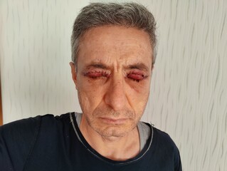 Obraz premium Man with swollen eyes and sutures recovering two days after upper blepharoplasty and Muller muscle surgery.