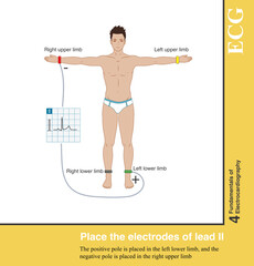Lead Ⅱ is a standard limb lead, with the positive pole placed in the left lower limb and the negative pole placed in the right upper limb.
