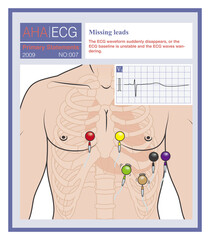When the leads of the electrocardiogram fall off, most often in the chest leads, the ECG waves in that lead may suddenly disappear. Do not misdiagnose this as cardiac arrest.
