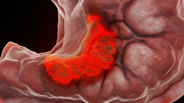 Close-up animation of a human stomach lining showing inflammation and abnormal cell growth, representing gastritis or early-stage cancer.
