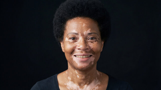 Senior woman with a warm smile and vitiligo embraces body positivity in a dark setting