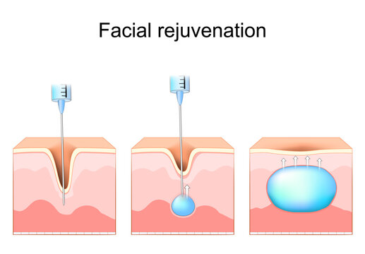 Facial rejuvenation. Anti-aging treatments. Wrinkle Before and after Dermal fillers