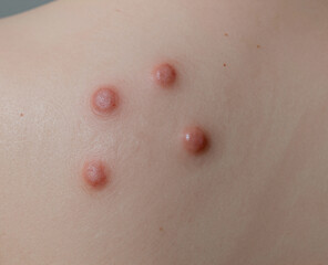 Fototapeta premium Four dome-shaped, reddish-pink papules or nodules are visible on the light-toned skin, indicating a dermatological condition.
