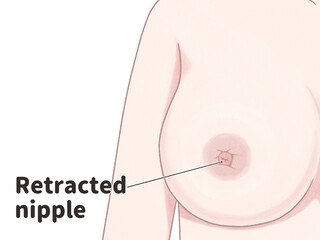 Breast cancer symptoms Retracted nipple Medical diagram