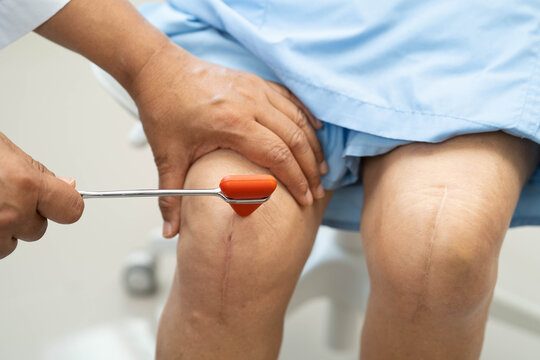 Doctor neurologist testing reflex knee with hammer and show Asian senior scars surgical total knee joint replacement.