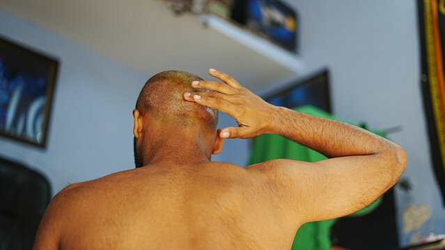 Close-up image of a patient gently applying healing cream to the donor area on the scalp three days after a hair transplant.