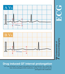 When the ST segment of the de Winter T wave changes from depressed to elevated, it indicates progression to acute AMI, with myocardial ischemia spreading from subendocardial to epicardial.
