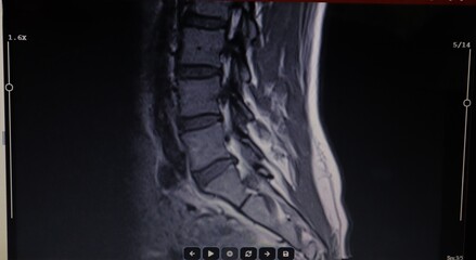 Doctor examines an MRI scan of the lumbar spine, highlighting a mild broad-based L5-S1 disc protrusion. Ideal for medical education, spinal health awareness and diagnostic