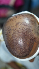 Top-angle close-up of a healing scalp after a hair transplant surgery. The image shows hundreds of implanted grafts