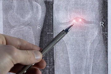 Doctor learn X-ray with narrowed joint space, compacted tibial endplate, exacerbation of...