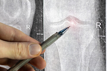 Doctor learn X-ray with narrowed joint space, compacted tibial endplate, exacerbation of...