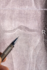 Doctor learn vertical X-ray with narrowed joint space, compacted tibial endplate, exacerbation of intercondylar elevation of the tibia. Osteoarthritis of the knee joint.