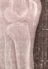 Doctor learn vertical X-ray with narrowed joint space, compacted tibial endplate, exacerbation of intercondylar elevation of the tibia. Osteoarthritis of the knee joint.