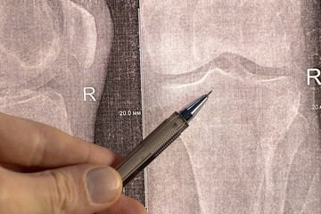Doctor learn X-ray with narrowed joint space, compacted tibial endplate, exacerbation of intercondylar elevation of the tibia. Osteoarthritis of the knee joint.