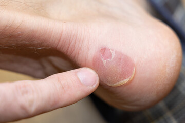 Heel blister with peeled skin close-up