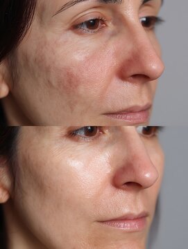 One side of the skin looks rough, dull, and dehydrated, compared to the other, with a bright, smooth tone.
