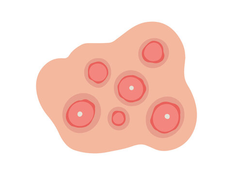 Acne Cystic in Face Skin
