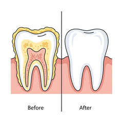 Comparison of healthy tooth and decayed tooth in cross-section