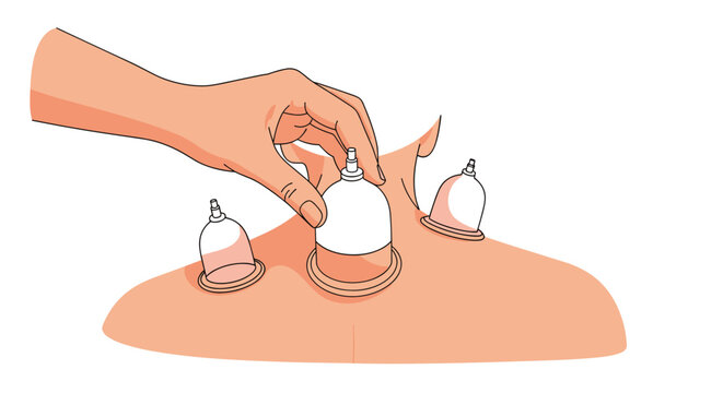 A person's hand places a cupping therapy cup on another person's upper back or neck area, showing the alternative medicine practice.