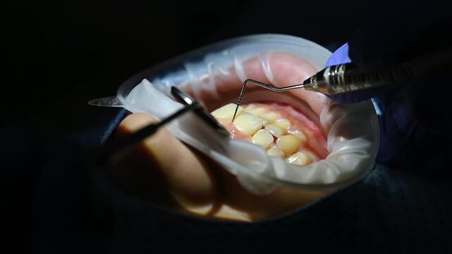A close-up shot of the doctor using a periodontal probe to examine the upper teeth