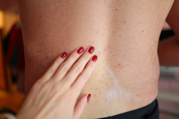 Close up of a hand applying soothing cream to psoriasis patches on a mans back useful for dermatology topics skincare tutorials and health awareness content