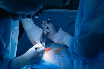 Surgeons performing knee surgery in operating room with precision and care, umbilical hernia removal
