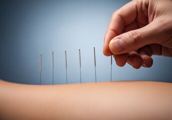 Professional hand inserting acupuncture needles into patient for pain relief therapy