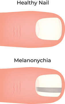 Healthy Nail vs Melanonychia A Visual Comparison